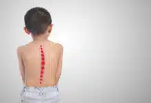 scoliosis in children