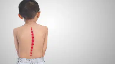 scoliosis in children