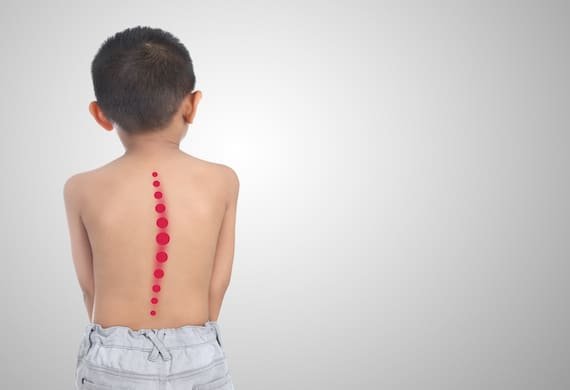 scoliosis in children