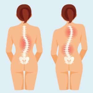 scoliosis in children treatment