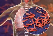 Philippines is eradicating tuberculosis with India's cooperation